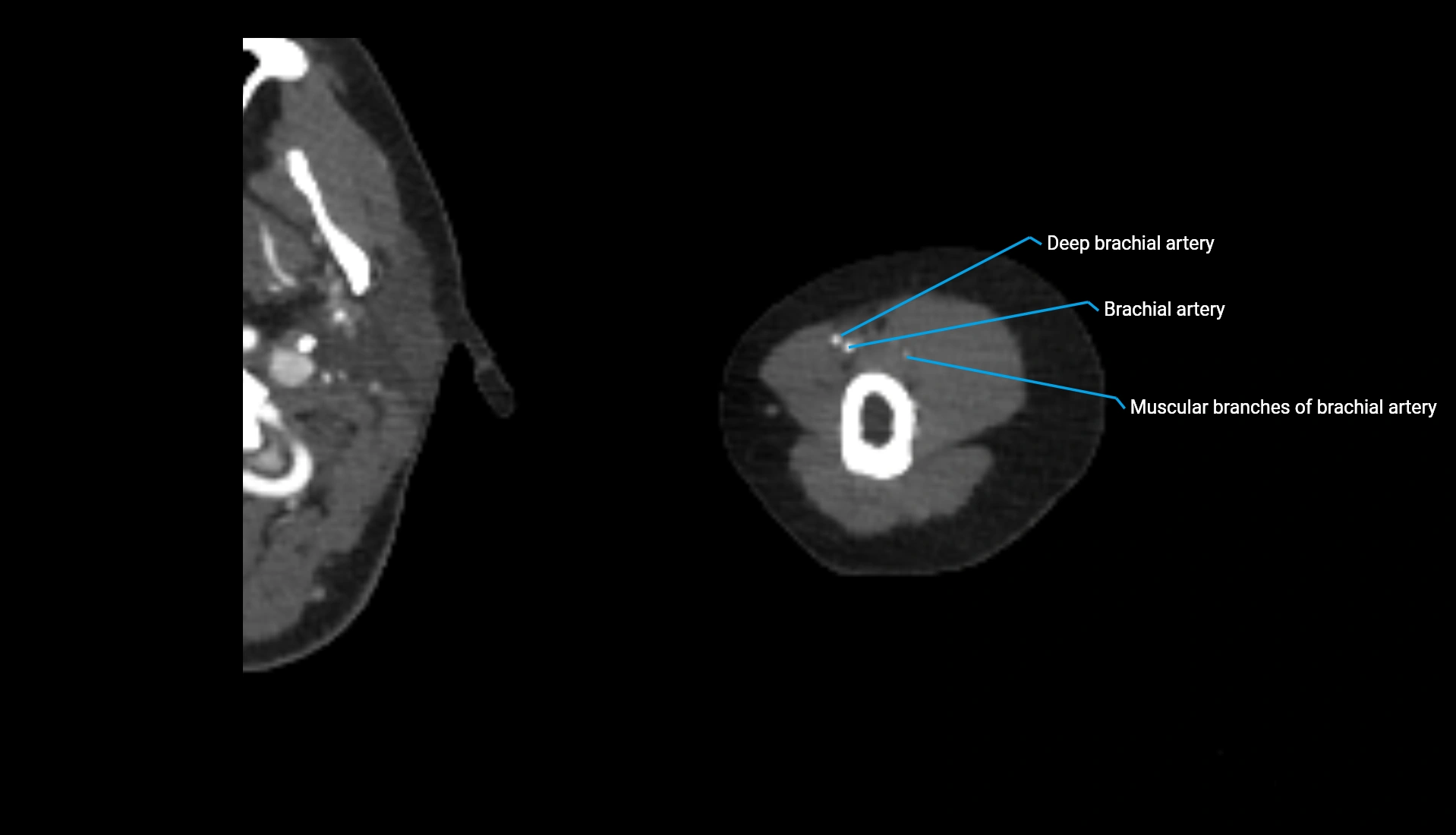 CTA upper limb axial cross sectional anatomy labelled image 275 (2).webp